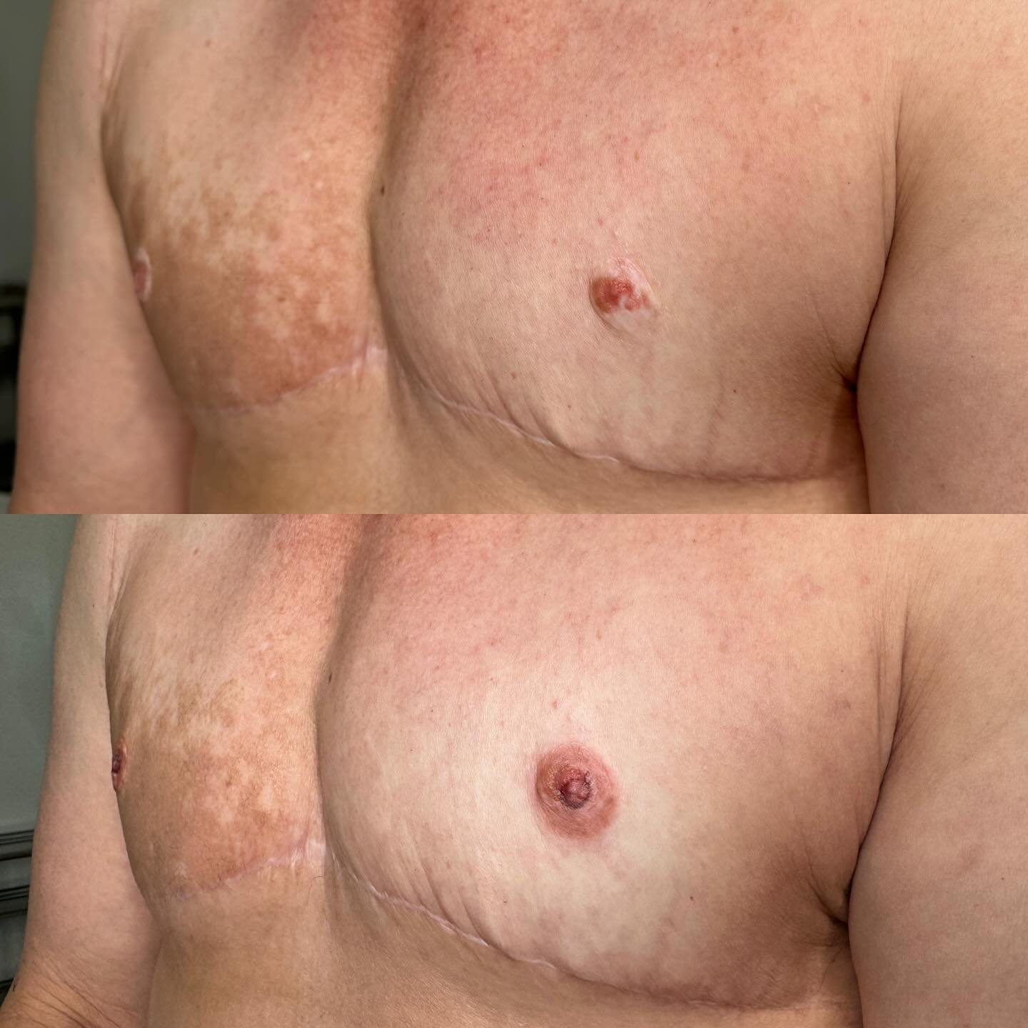 The magic and healing power of restorative tattooing 🫶🏼 It is such an honor to be trusted for a special tattoo like this, and the biggest compliment I could receive is that they couldn&rsquo;t stop showing off their new nipples to friends after get