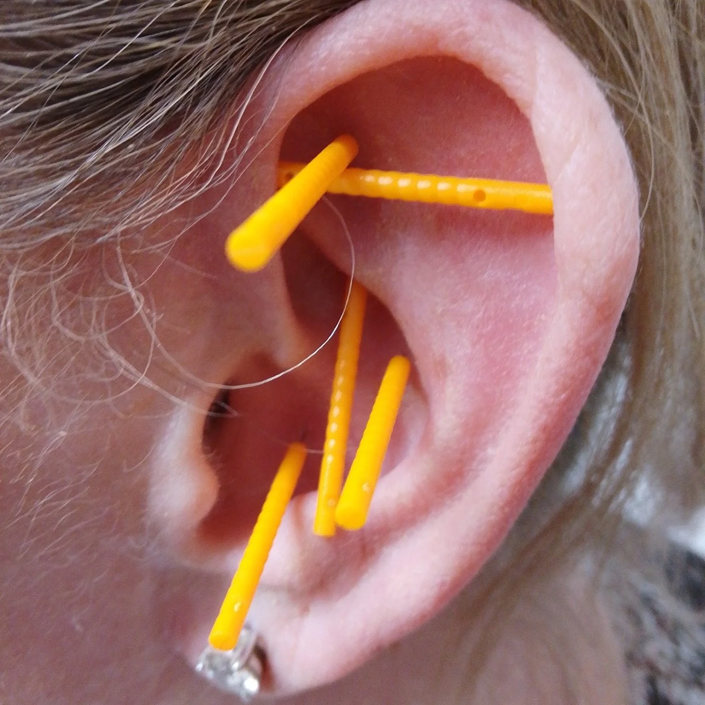 Our fantastic recovery worker, Jana, qualified as a NADA therapist in May 2025 and has since been running weekly auricular acupuncture sessions in our women&rsquo;s refuges.

Each session offers clients a complimentary 40-minute holistic treatment, a