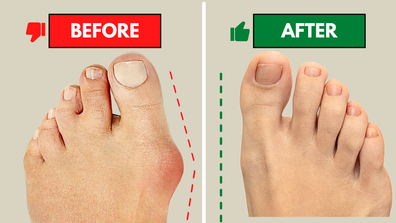 How to Treat Bunions without Surgery (Exercises &amp; Treatment)