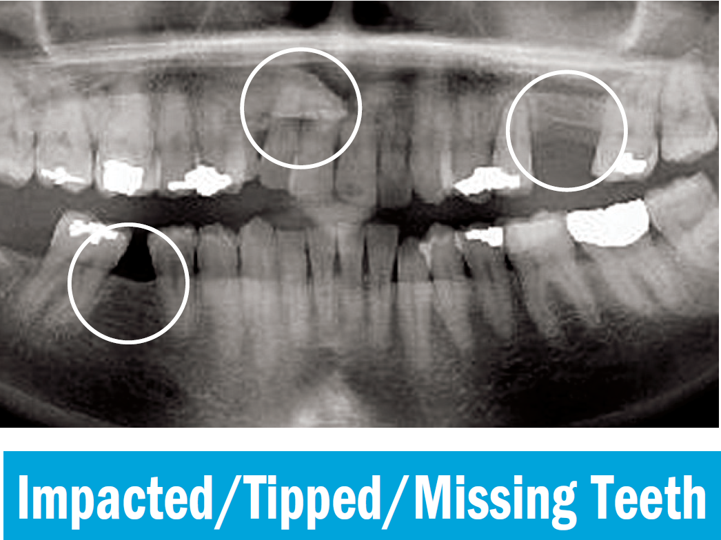 Impacted teeth.PNG