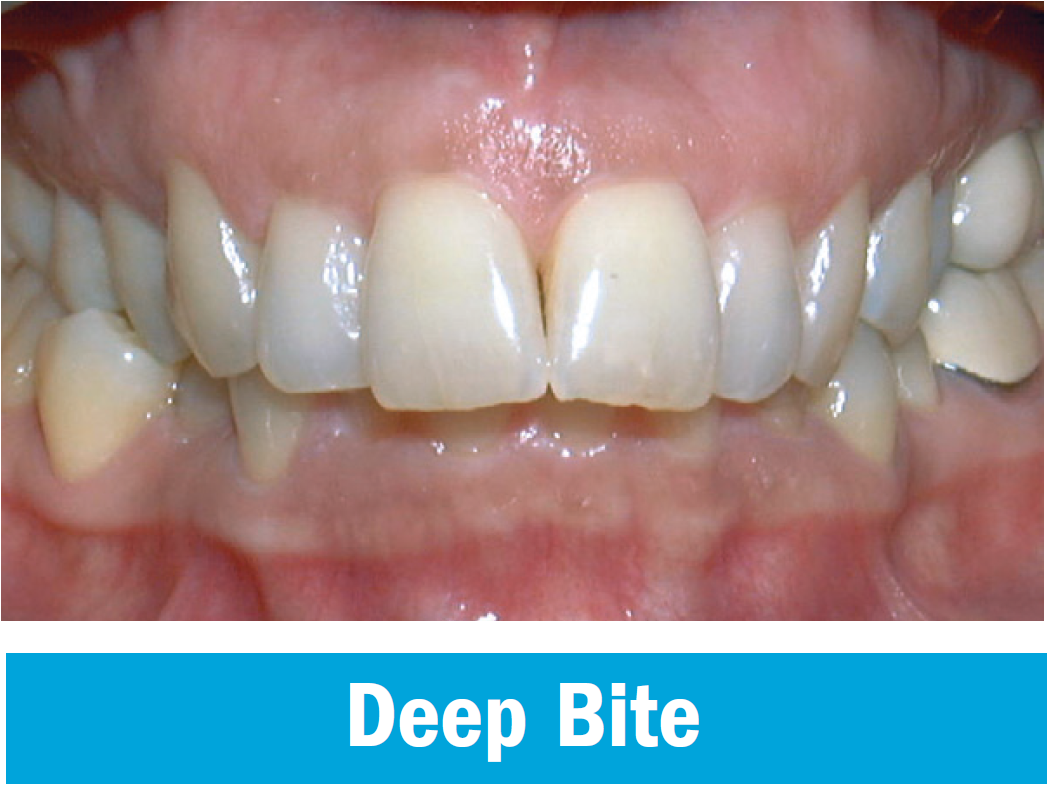 Deep Bite.PNG