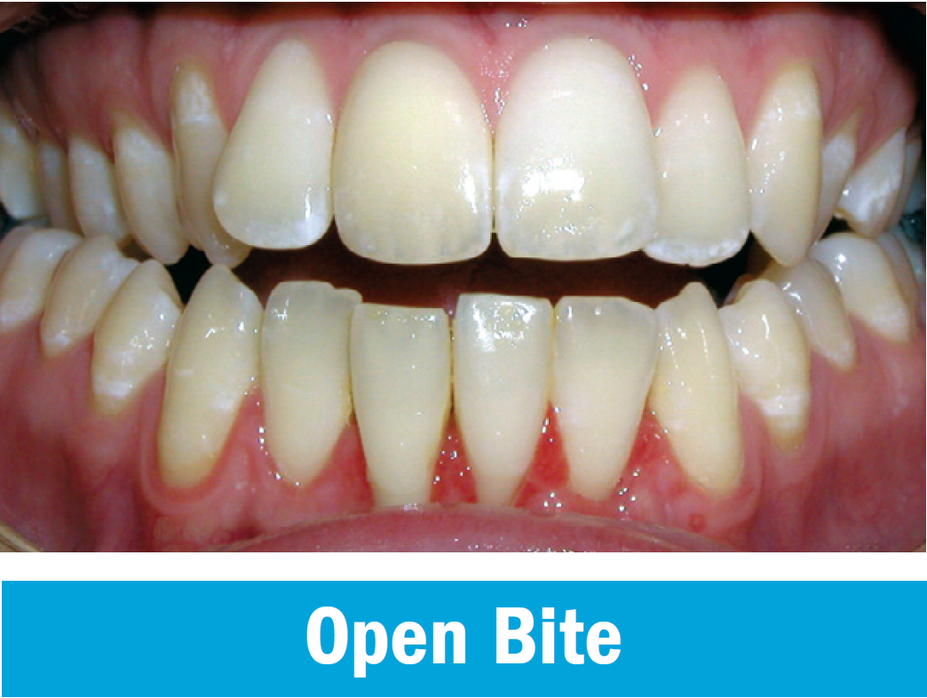 OPen Bite.PNG