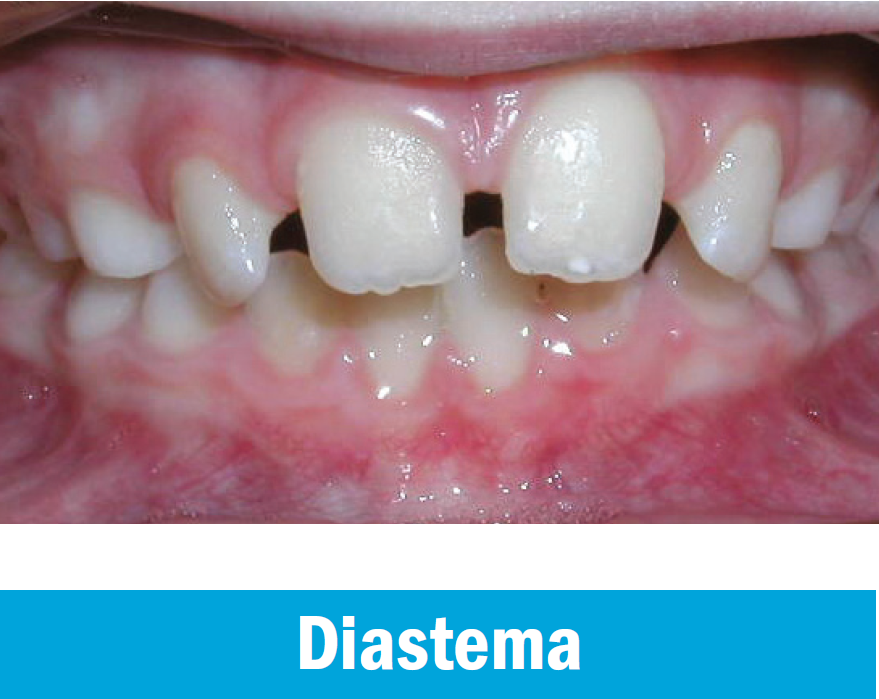 Diastema.PNG