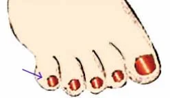 Breech-Moxibustion.jpg