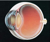 Vertroebelde lens: Cataract