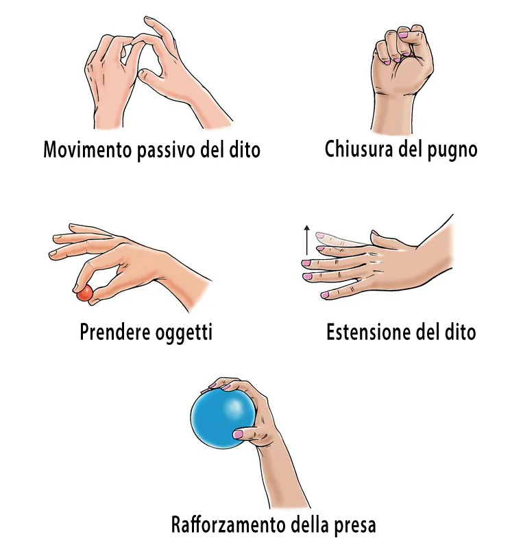 Tempi Guarigione Rottura Tendine Dito Medio La rottura sottocutanea del tendine estensore o “dito a martello”