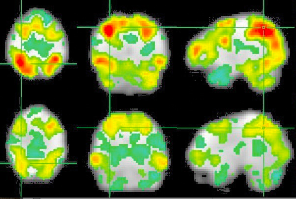 Can the Celebration of Creativity Help Destigmatize Mental Illness?