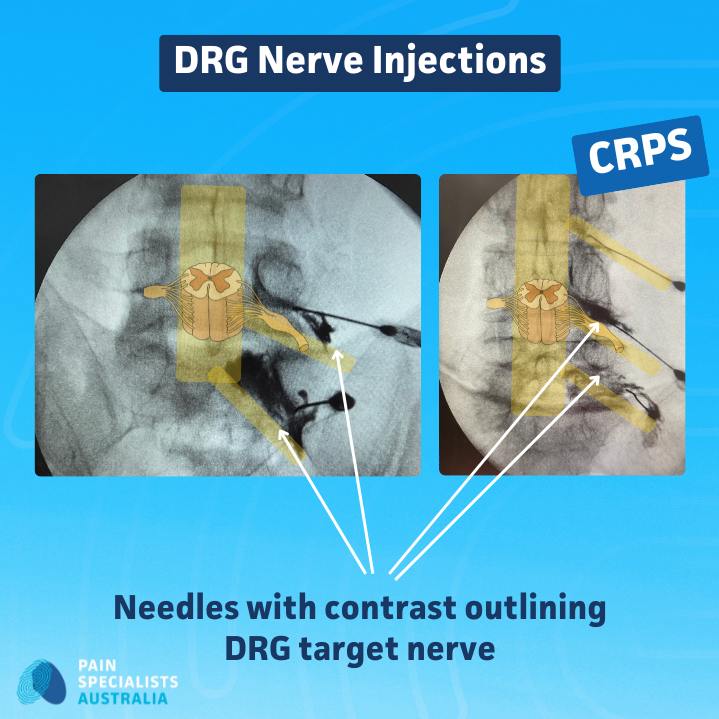 Fluoroscopy images showing DRG nerve injection with contrast outlining the targeted nerve for CRPS treatment.