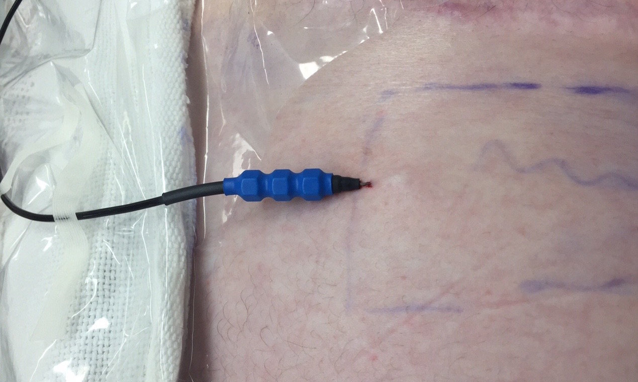 This is what the needle looks like when it’s under the skin and performing the nerve stimulation. You can also see the area of pain marked off.