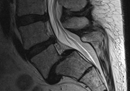 Figure 6. Spondylolisthesis of L5 on S1 (Drawing by PumpingRudi under Creative Commons Attribution-Share Alike 3.0 Unported)