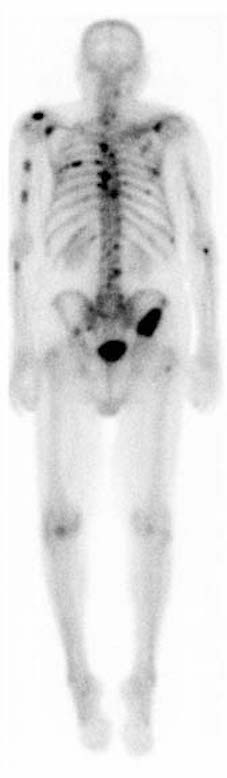 Figure 7. Bone scan showing prostatic cancer in various parts of the spine. (Drawing by RadsWiki under Creative Commons Attribution-Share Alike 3.0 Unported)