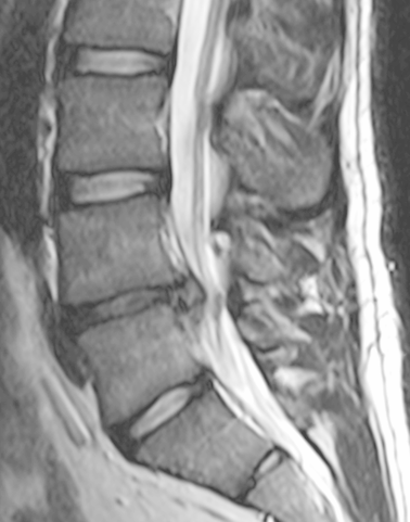 A PAIN IN THE ASS! UNDERSTANDING AND MANAGING CHRONIC LOWER BACK PAIN.