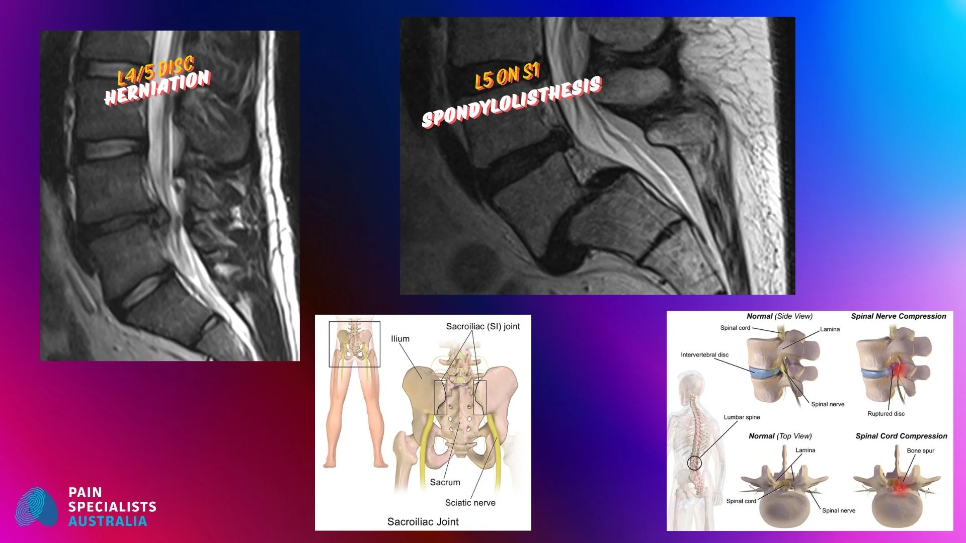 Why is Back Pain Such a Pain?