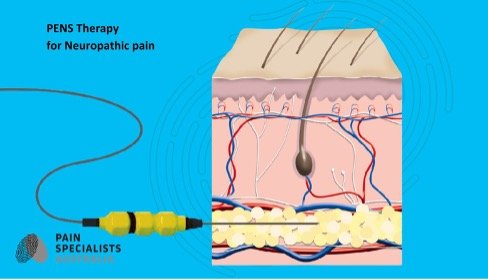 Understanding Percutaneous Electrical Nerve Stimulation (PENS) for ...