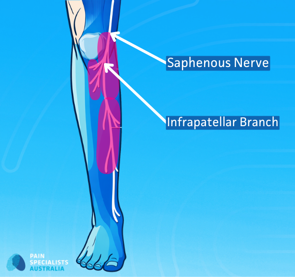 Diagram showing the saphenous nerve and infrapatellar branch as causes of inner knee pain.