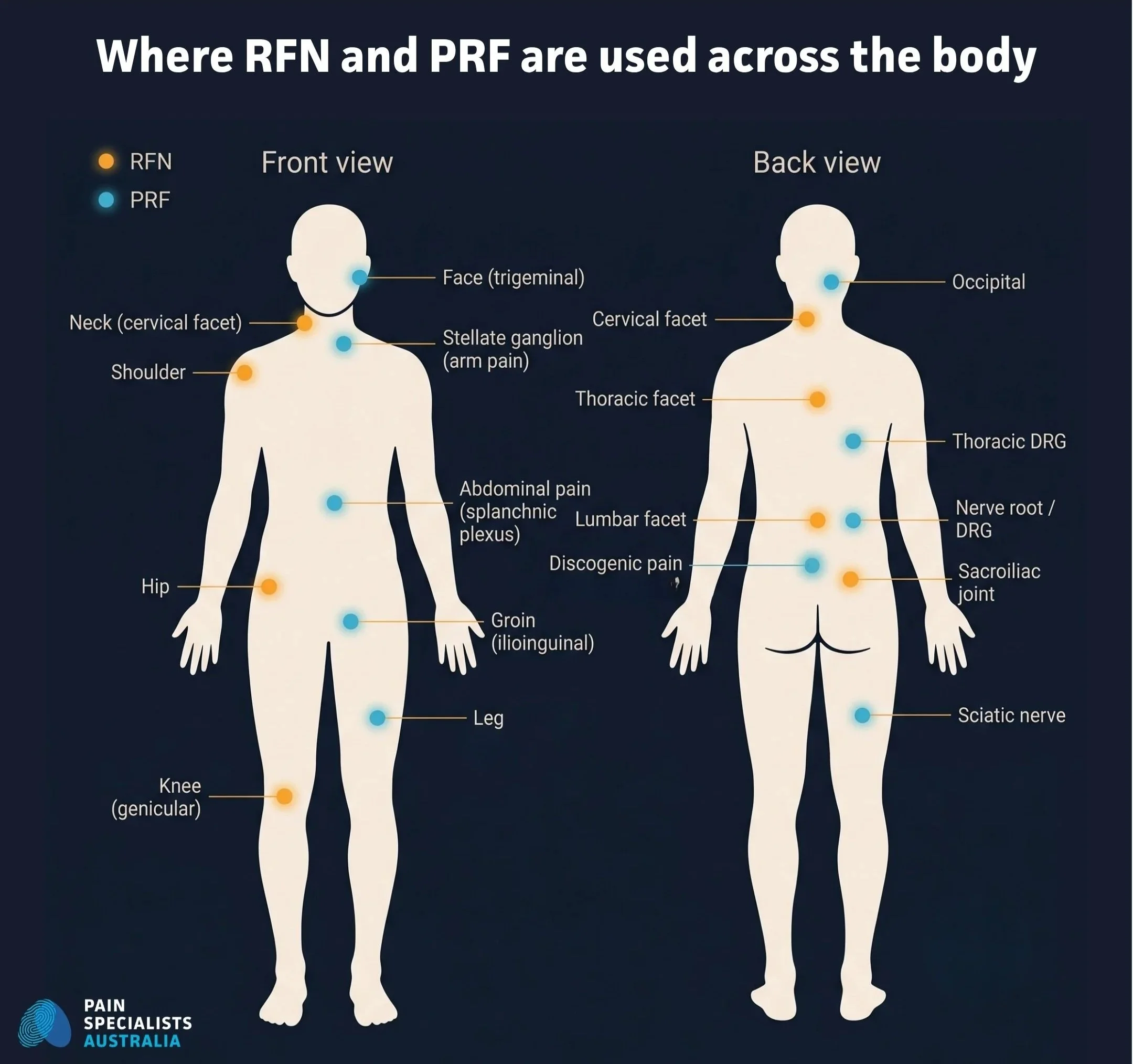 Body map illustrating different areas treated with RFN and pulsed radiofrequency at PSA Melbourne.