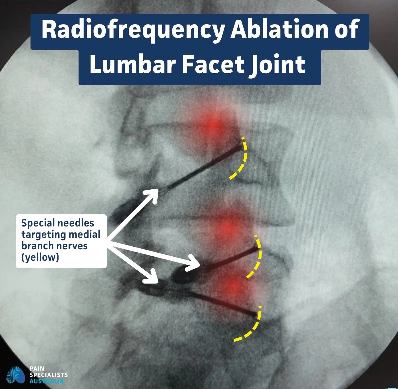 Diagram of facet joint medial branch nerves targeted in radiofrequency neurotomy. Minimal label: 'Medial branch nerve' with arrow only.