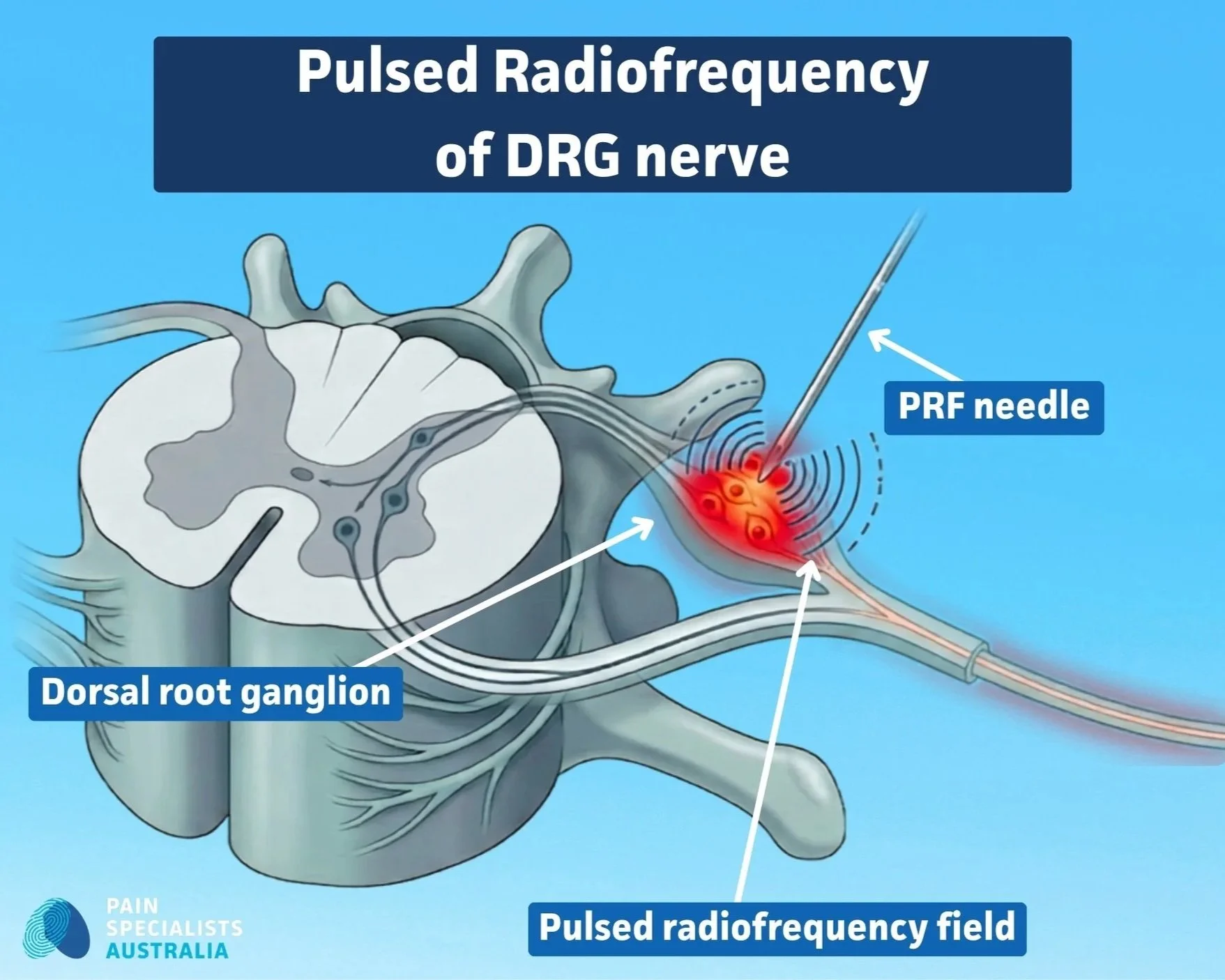 An illustration showing a PRF needle providing electrical filed current to a DRG spinal nerve to treat chronic pain