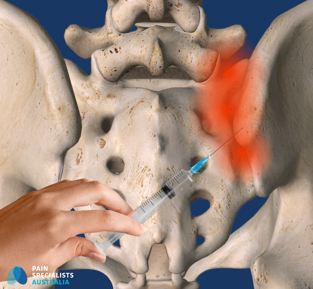 Si Rfa Cpt Code Sacroiliac Joint Pain Treatment in Melbourne — Pain Specialists Australia