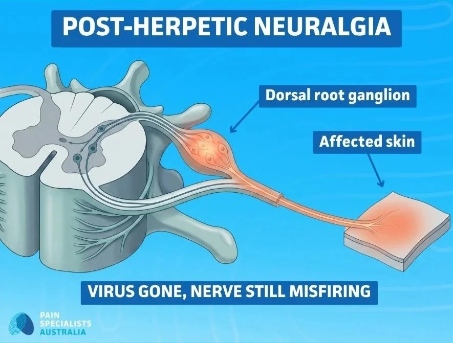 Diagram of dorsal root ganglion and dermatomal nerve pathway in post-herpetic neuralgia.