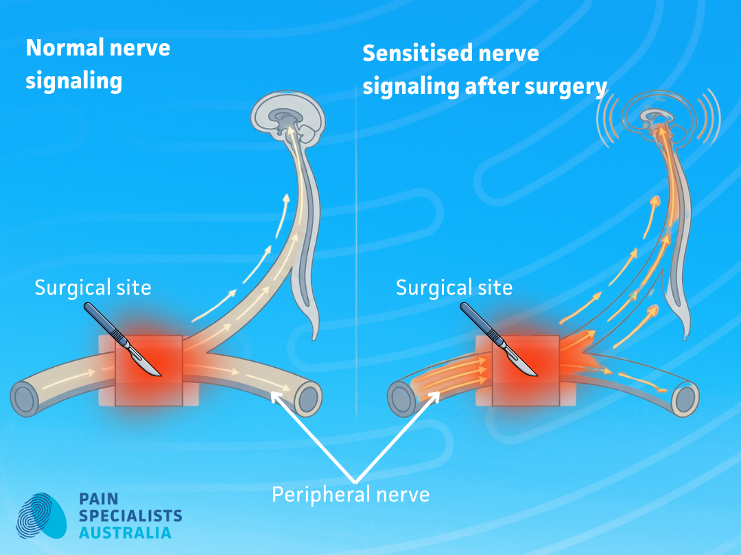 Diagram showing peripheral nerve injury and sensitised pain pathways causing chronic pain after surgery.
