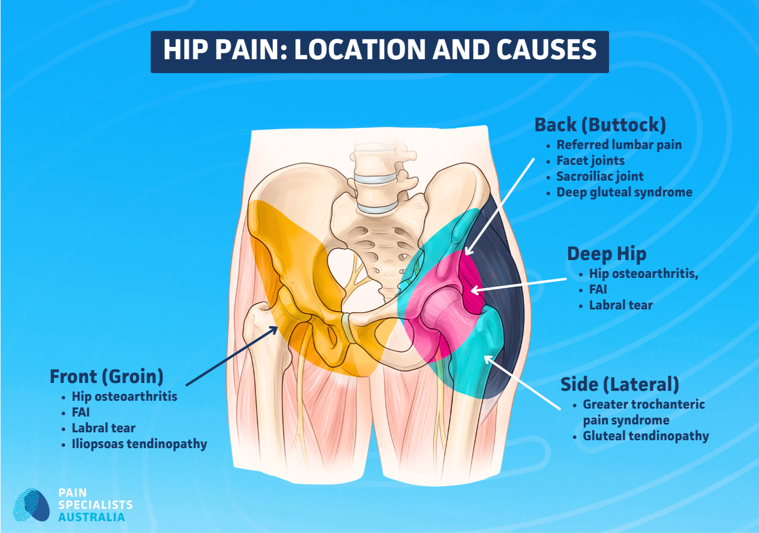 Hip pain location and causes map showing four pain zones (front/groin, lateral, back/buttock, deep hip) with common conditions in each zone, from Pain Specialists Australia.