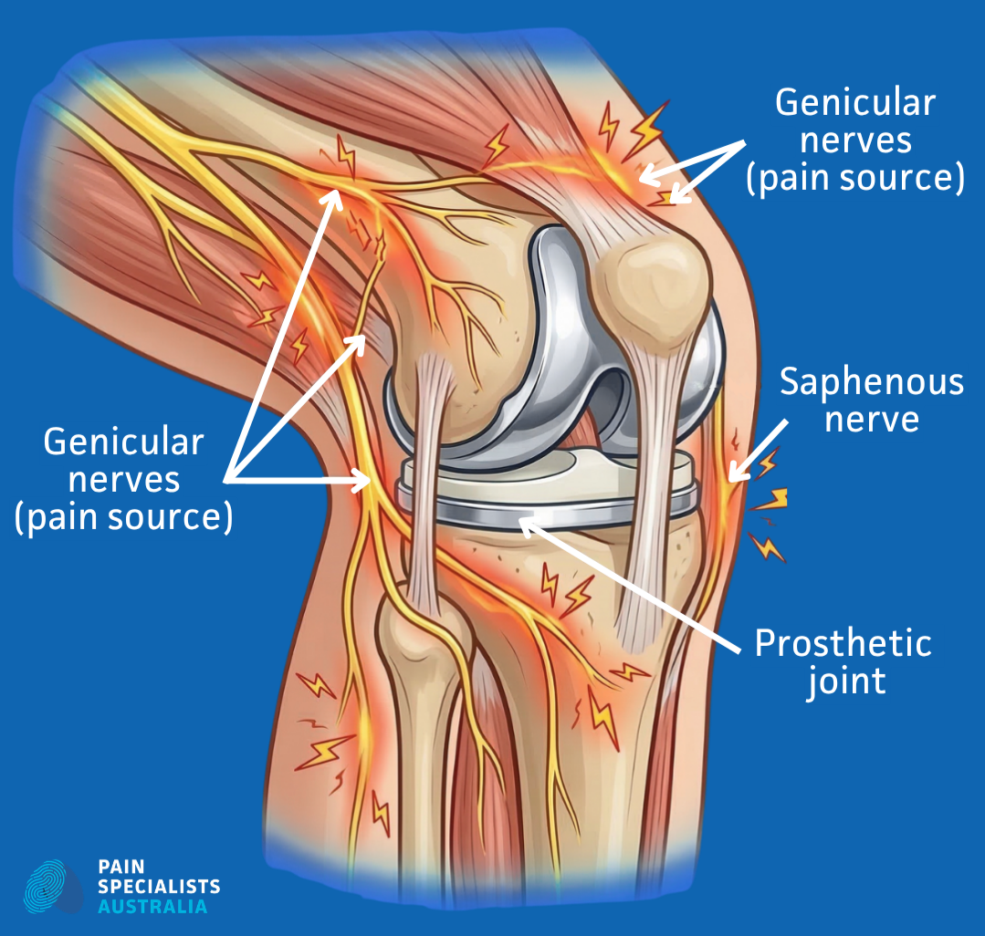 Medical illustration of saphenous and genicular nerves around a prosthetic knee joint for chronic pain diagnosis.
