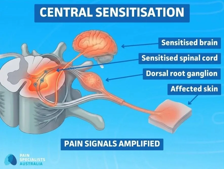 Illustration of central sensitisation in post-herpetic neuralgia showing ascending pain signals from the peripheral nerve through the spinal cord to the brain
