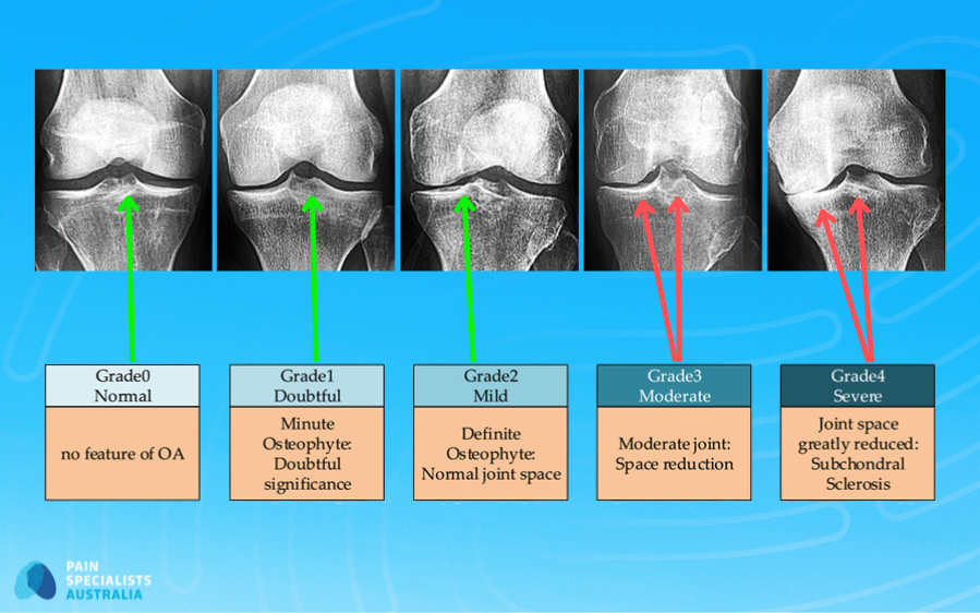 Infographic showing Kellgren–Lawrence grades 1 to 4 knee osteoarthritis with example images.