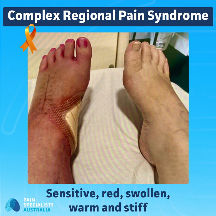 CRPS warm phase showing redness, swelling, warmth and skin changes in the foot.