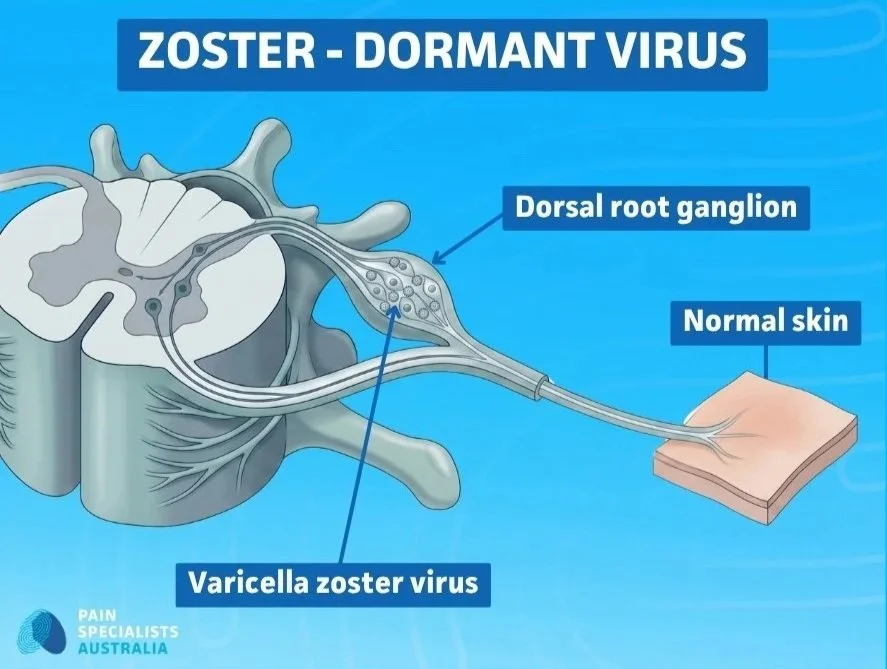 Medical illustration showing the varicella zoster virus lying dormant in the dorsal root ganglion, which can reactivate to cause shingles and post-herpetic neuralgia.