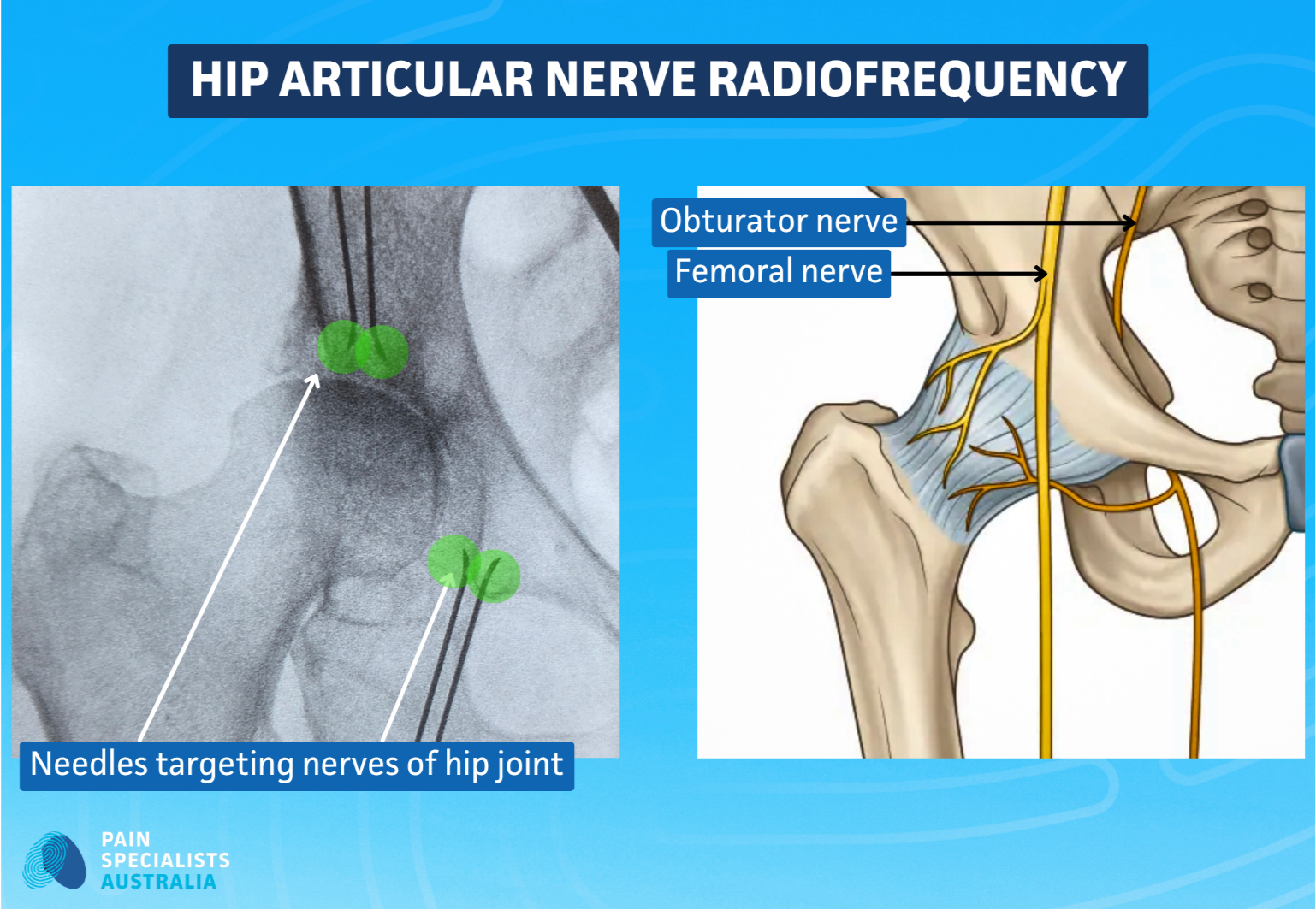 Radiofrequency ablation of the hip articular nerves performed by a Melbourne pain specialist for chronic hip pain.