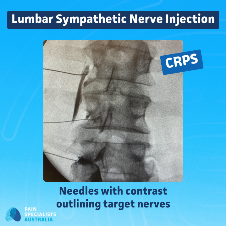 Fluoroscopy-guided lumbar sympathetic nerve injection with contrast outlining target nerves for CRPS.