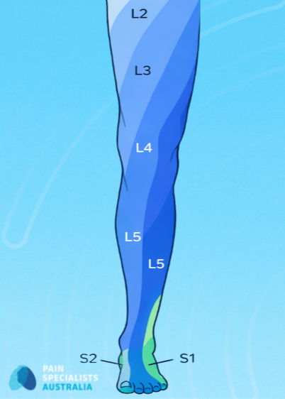 Illustration showing L3 and L4 nerve roots referring pain to the knee.