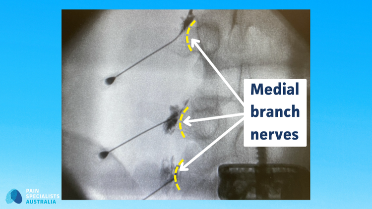 Lmnbb Facet Joint Injections and Radiofrequency Melbourne | Back Pain Experts ...