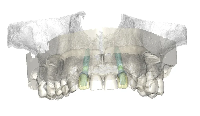 3D implant planning software