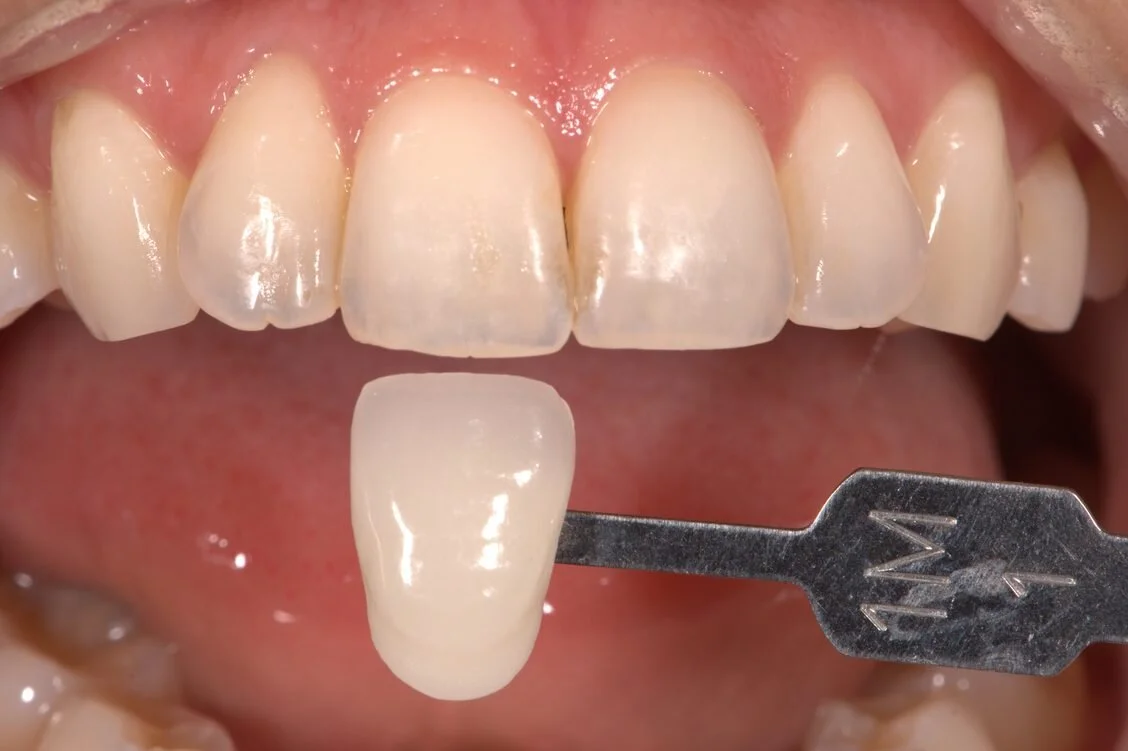Top 5 Tips To Take More Effective Photos - From A Dental Lab