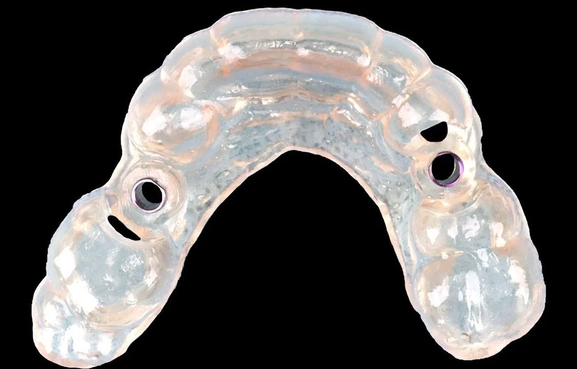 Experience The Benefits Of Surgical Guides: Improve Implant Efficiency &amp; Results