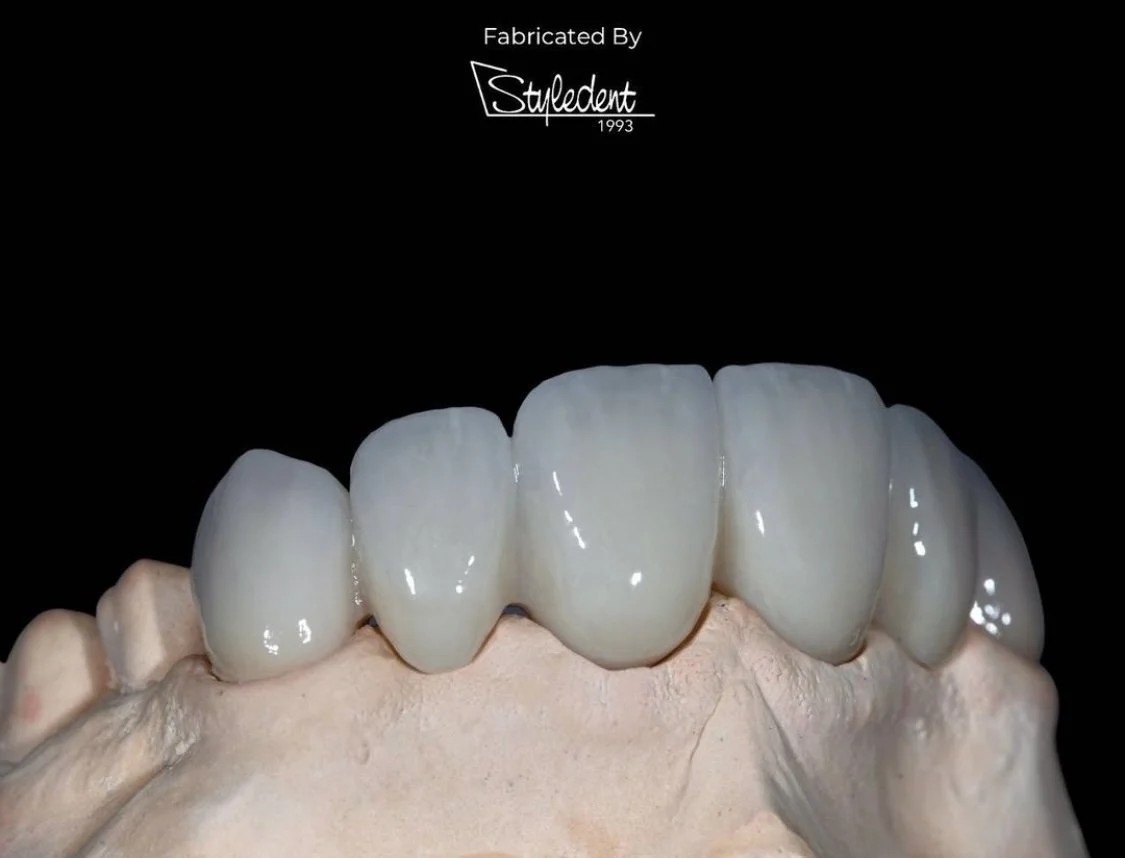 Our Commitment To Lasting Dental Restorations: Building Bridges