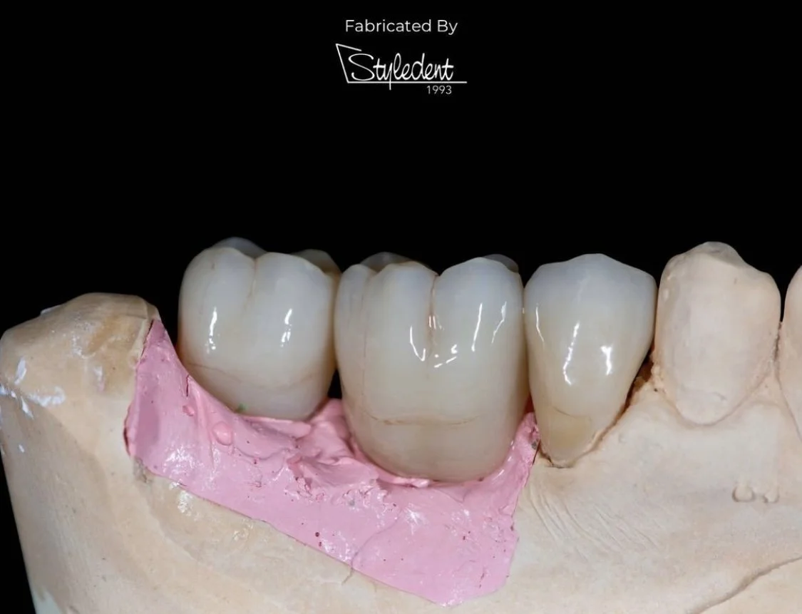 A Comprehensive Guide To Choosing The Best Type Of Dental Crowns For Your Patients