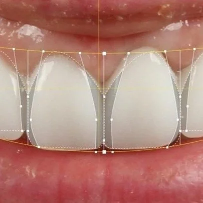 Revolutionizing Full Arch Zirconia Cases: The Game-Changing Benefits of Photogrammetry in Dentistry