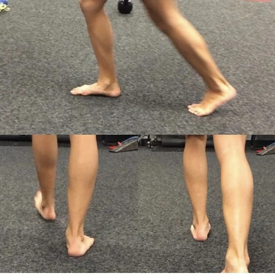 Image above is one of my self. The Bottom left image is my weight bearing right foot, and you can see that compared to right image of my weight bearing left foot, the inner aspect of my mid foot is different. In the left image my right mid foot drops compared to the picture of the right where you don't see that on my left foot. I was asymptomic for months until I started running 18 + miles, i ended up developing foot pain. Imagine all the strain my foot endured every step I took and landed like the picture on the right? 