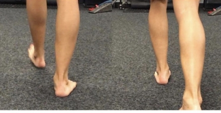 Loading phase: Right foot: midfoot pronated and foot externally rotated, vs the left foot . History of posterior tibialis tendonitis on the Right Foot.