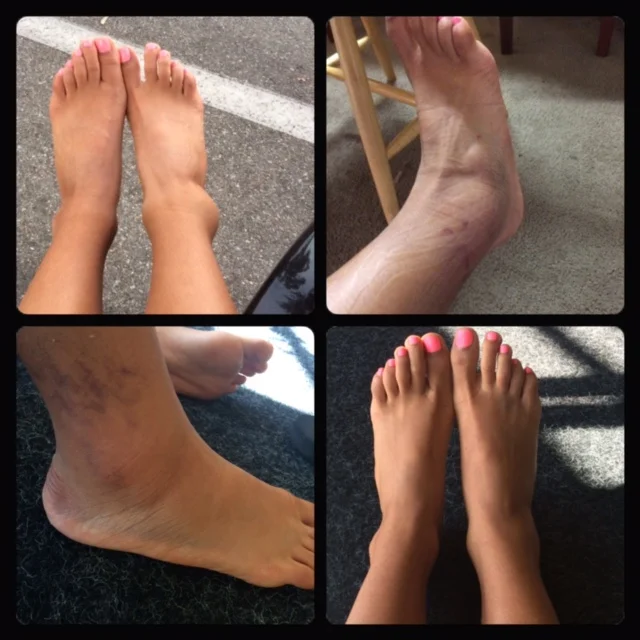 My grade III sprain progression: Day 1, Day 2, Week 2, Week 4 (2015)