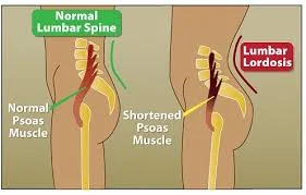 psoas stiffness.jpg