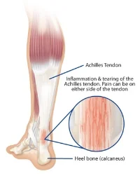 AchillesTendonitis.jpg