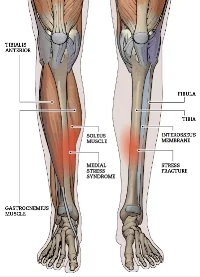 shin splints.jpg