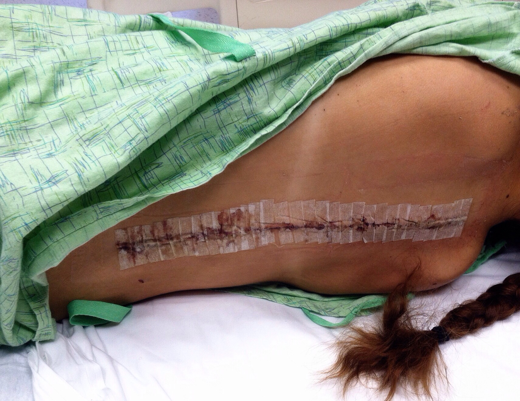 This picture was taken the first time the doctors changed my bandages. I made my dad take this picture because I was concerned they didn't line up my tan lines from my bathing suit and I didn't believe him when he told me they did.