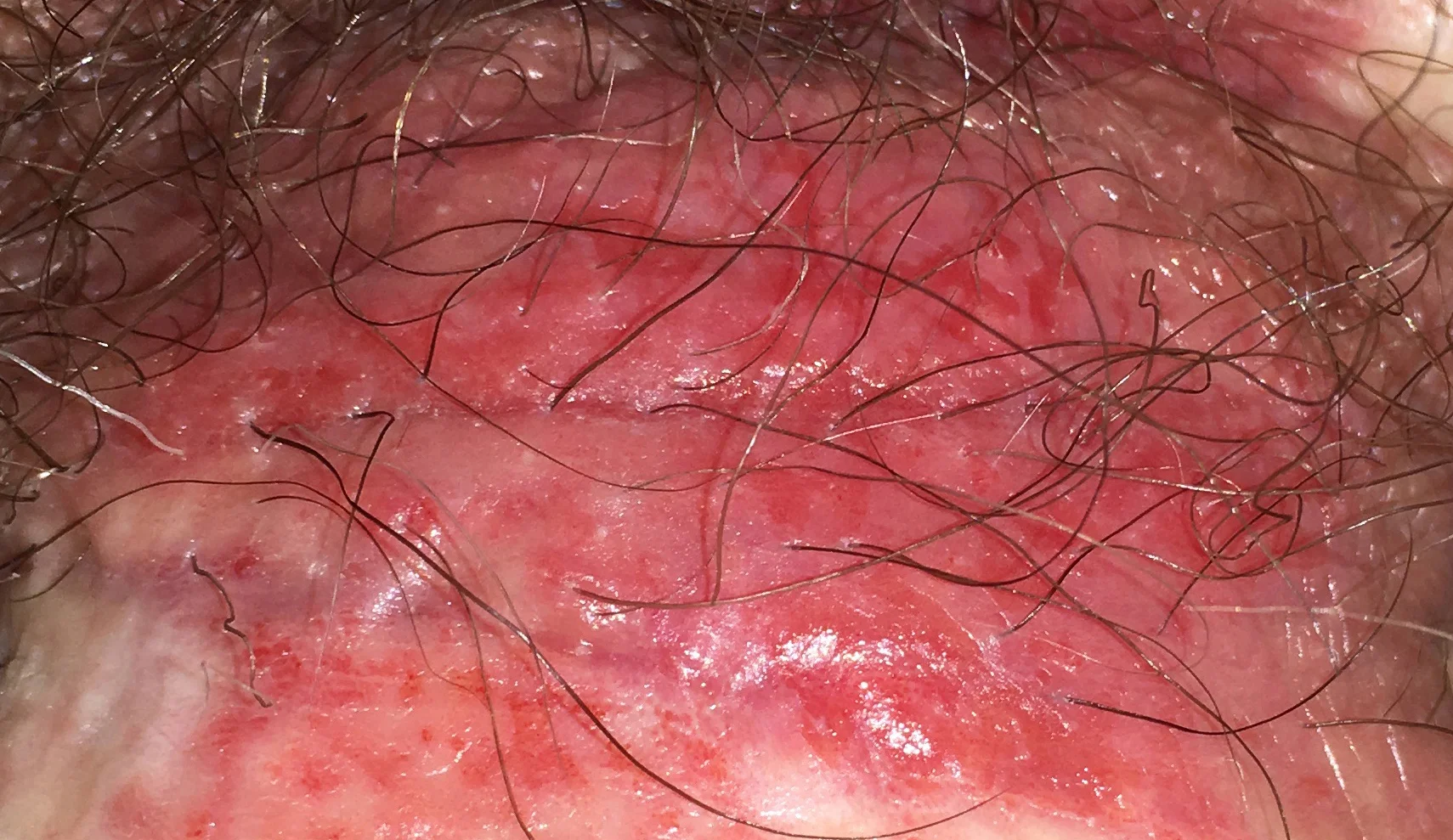 Genital Area Redness