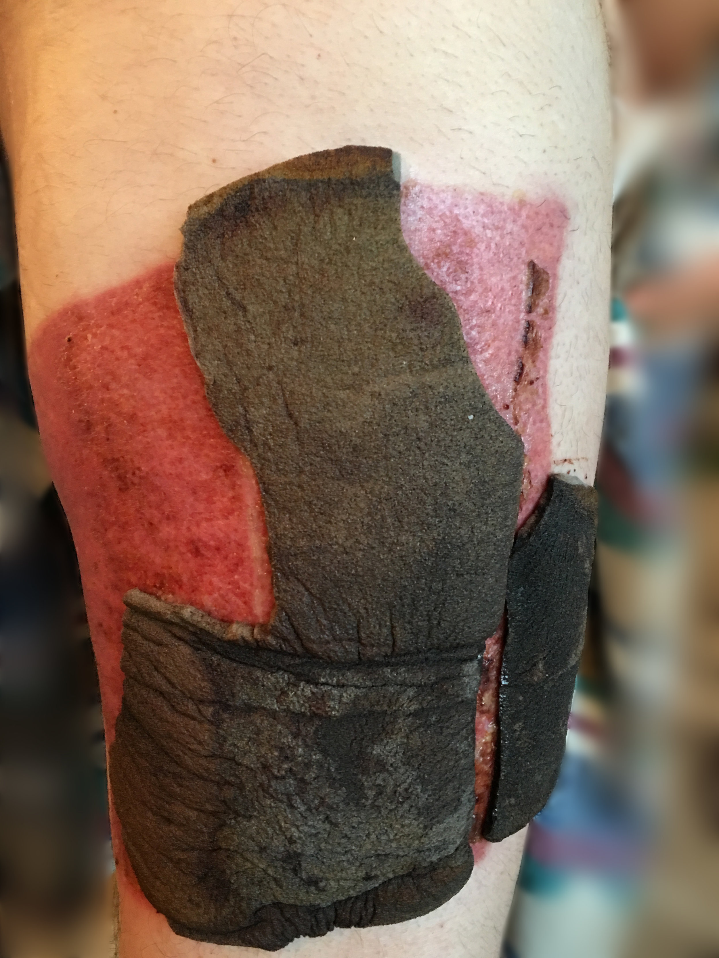 As the donor site for the split-thickness skin graft heals, the foam bandages release. This photo was taken nine days after surgery.